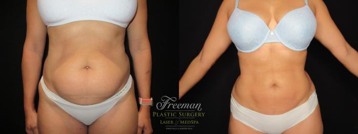 High Definition Liposuction Body Contouring