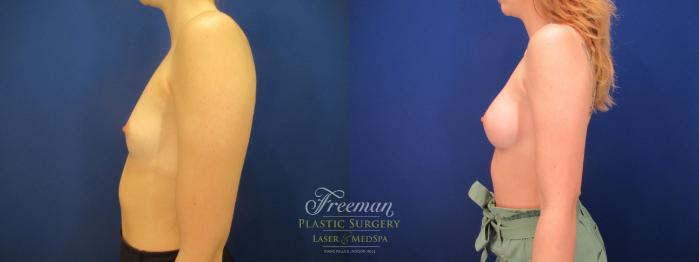 Breast Augmentation Before & After Photo | Idaho Falls, ID | Dr. Mark Freeman