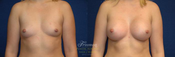 Breast Augmentation Before & After Photo | Idaho Falls, ID | Dr. Mark Freeman