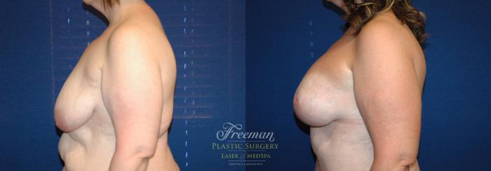 Breast Lift Before & After Photo | Idaho Falls, ID | Dr. Mark Freeman
