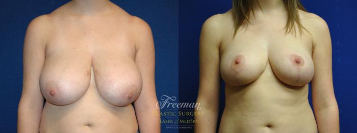 Breast Lift Before & After Photo | Idaho Falls, ID | Dr. Mark Freeman