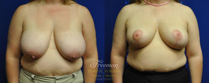 Breast Reduction Before & After Photo | Idaho Falls, ID | Dr. Mark Freeman