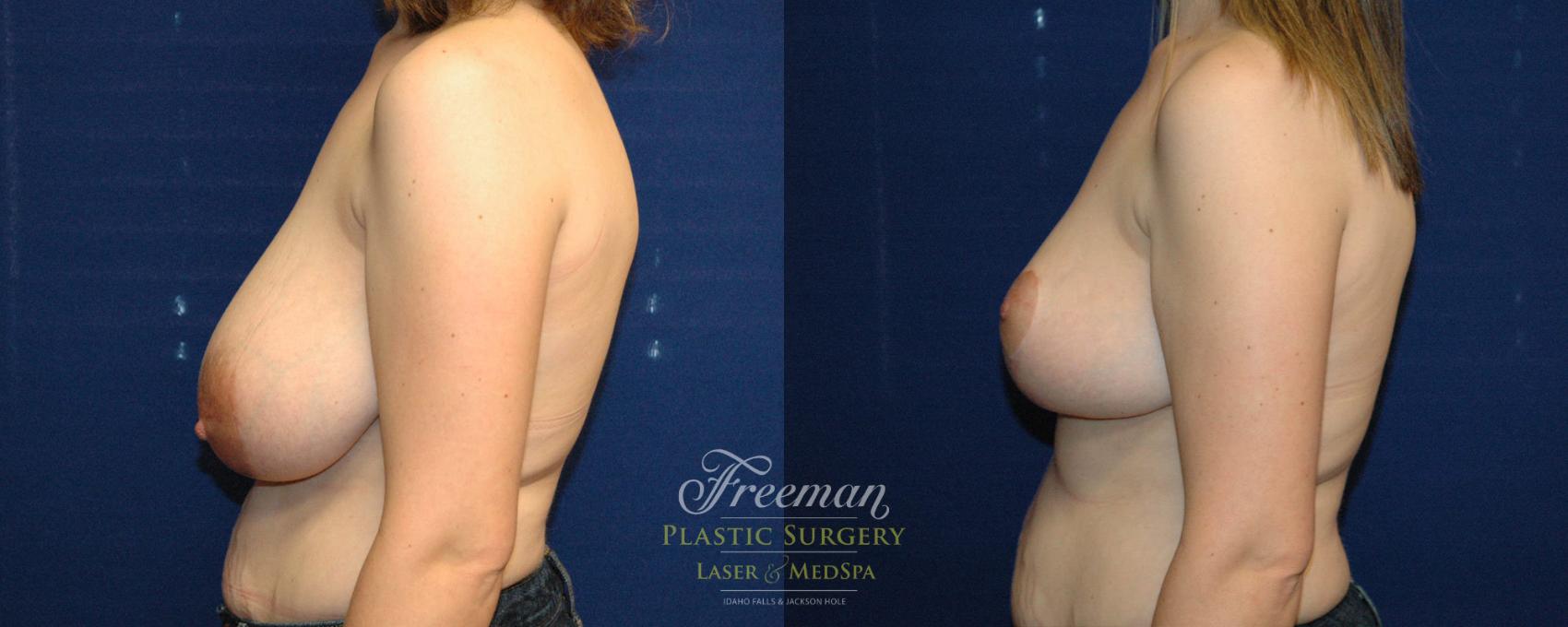 Breast Reduction Before & After Photo | Idaho Falls, ID | Dr. Mark Freeman