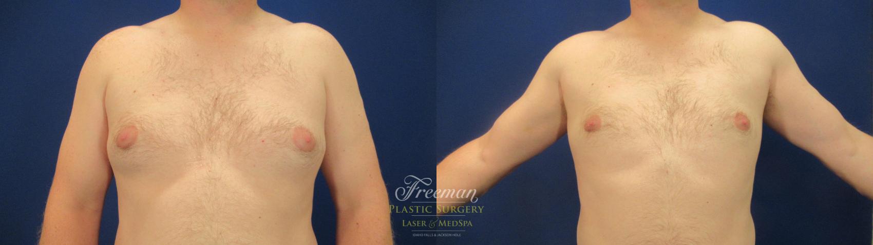 Breast Reduction Before & After Photo | Idaho Falls, ID | Dr. Mark Freeman