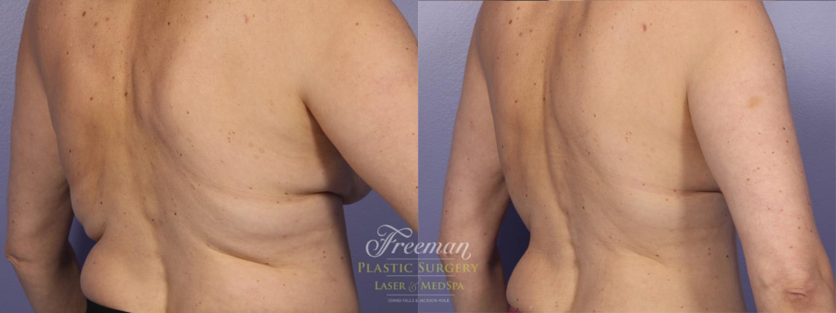 CoolSculpting® Before and After Pictures Case 35 | Idaho Falls, ID | Dr.  Mark Freeman