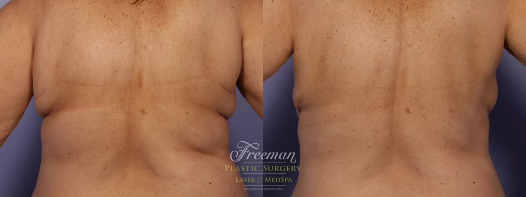 CoolSculpting - Flanks and Bra Strap Area Before & After Gallery - Case 4432