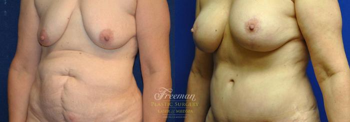 Mommy Makeover Before & After Photo | Idaho Falls, ID | Dr. Mark Freeman