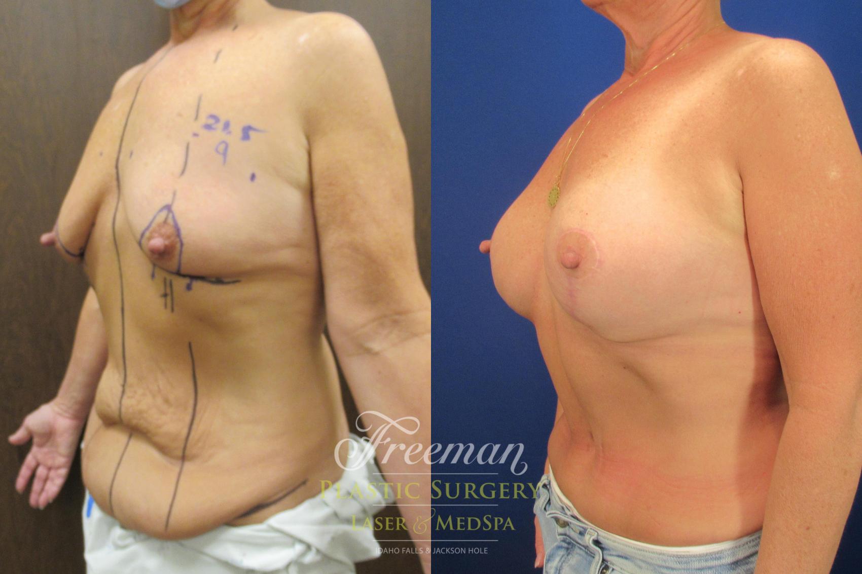 Breast Lift Surgery for Idaho Falls & Jackson Hole