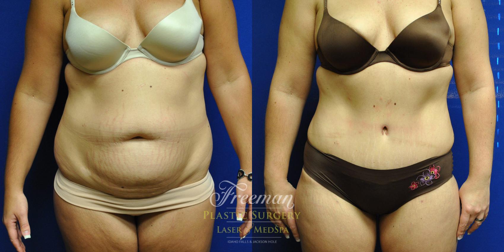 Tummy Tuck Before and After Pictures Case 10 | Idaho Falls, ID | Dr. Mark  Freeman
