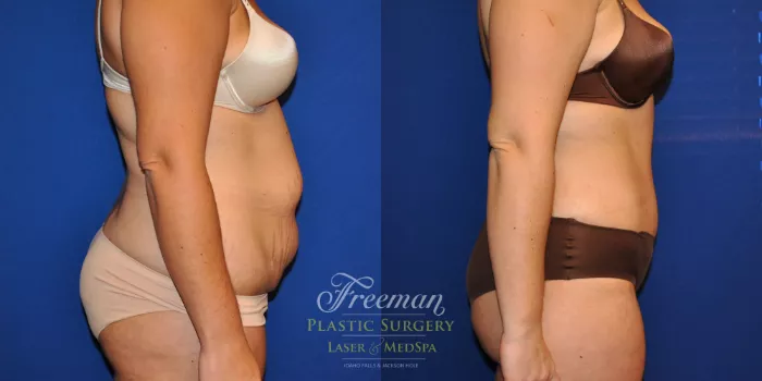 Tummy Tuck Before and After Pictures Case 16, Idaho Falls, ID