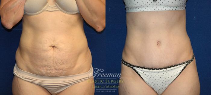 Tummy Tuck Before & After Photo | Idaho Falls, ID | Dr. Mark Freeman