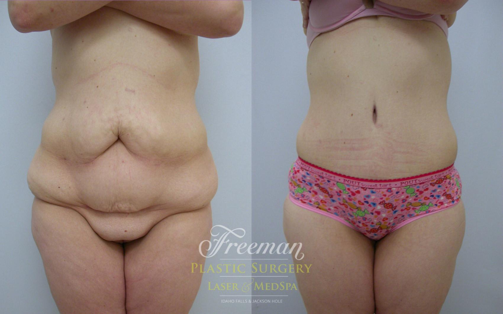 Tummy Tuck Before and After Pictures Case 16 | Idaho Falls, ID | Dr. Mark  Freeman