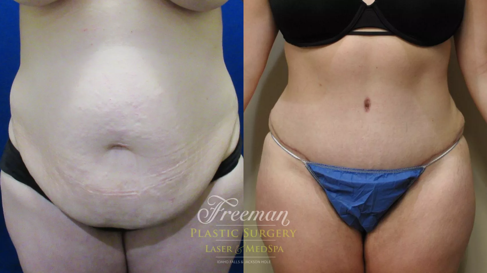 Patient Waist Tuck Before and Afters Waist Tuck Before After