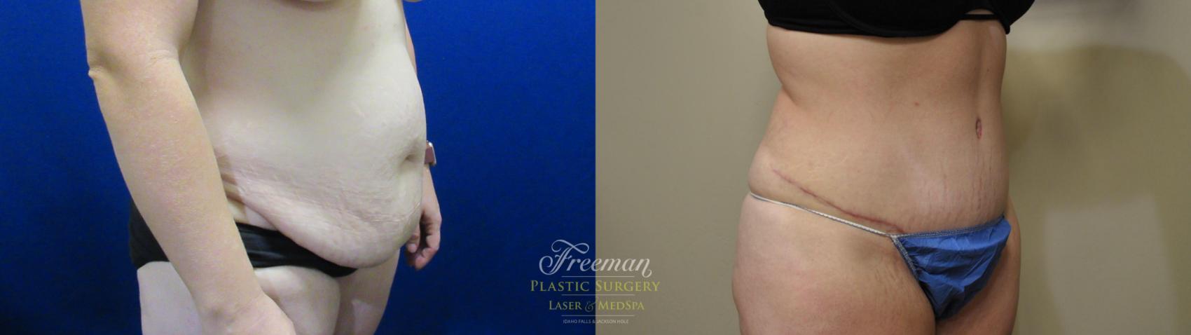 Tummy Tuck Before & After Photo | Idaho Falls, ID | Dr. Mark Freeman